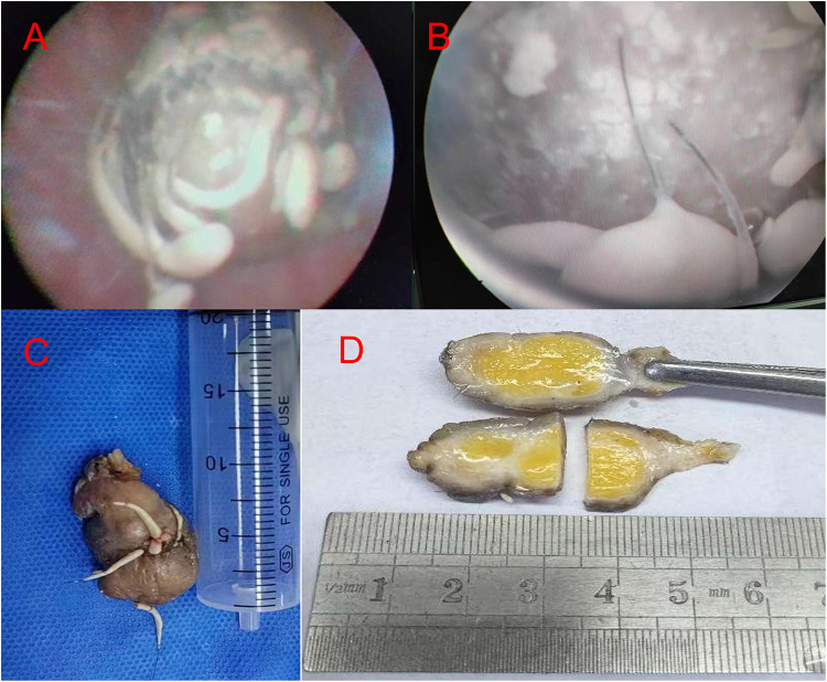 Mature Teratoma Combined with Bladder Stones: A Case Report and Literature Review.