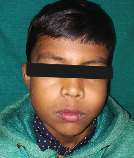 Gorlin-Goltz Syndrome with Jaw and Minimal Skin Manifestations - A Case Report.