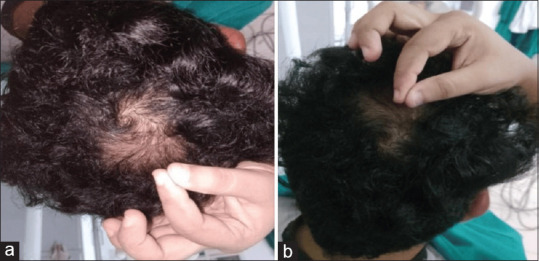 Efficiency of 5% Minoxidil and Platelet-rich Plasma Therapy in Androgenetic Alopecia - A Retrospective Study.