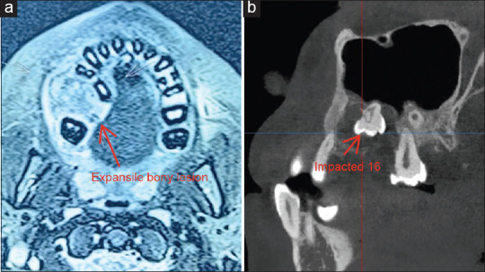 Central Giant Cell Granuloma of Posterior Maxilla - A Case Report.