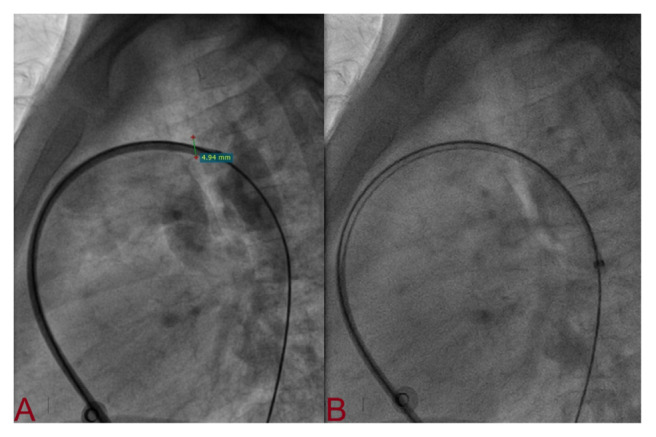 How to Avoid Arterial Access During Transcatheter Closure of Patent Ductus Arteriosus Using Anatomo-haemodynamic Landmark.