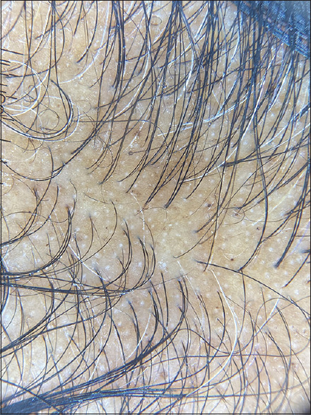 Telogen Effluvium Following Coronavirus Disease-2019 Infection: A Retrospective Study of 113 Cases.