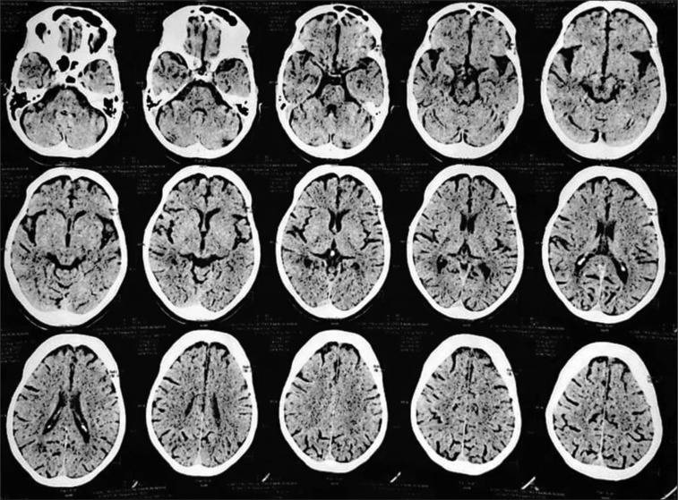 Distinctive lorazepam response in catatonia with cognitive impairment.