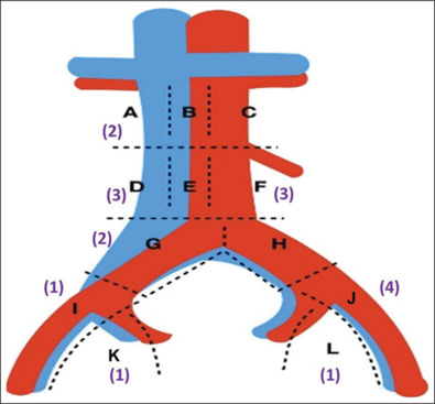 Sentinel Lymph Node Detection in Early-stage Ovarian Cancer Using Radionuclide Technetium-99m Sulfur Colloid - A Feasibility Study.