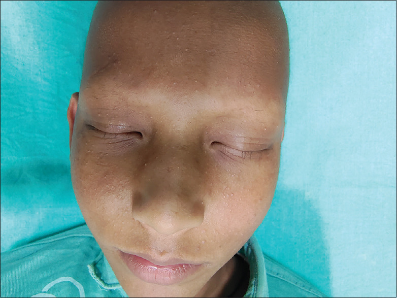 Atrichia Congenita with Papular Lesions: A Report of Rare Case Showing "Cluster of Stars' Appearance on Dermoscopy".
