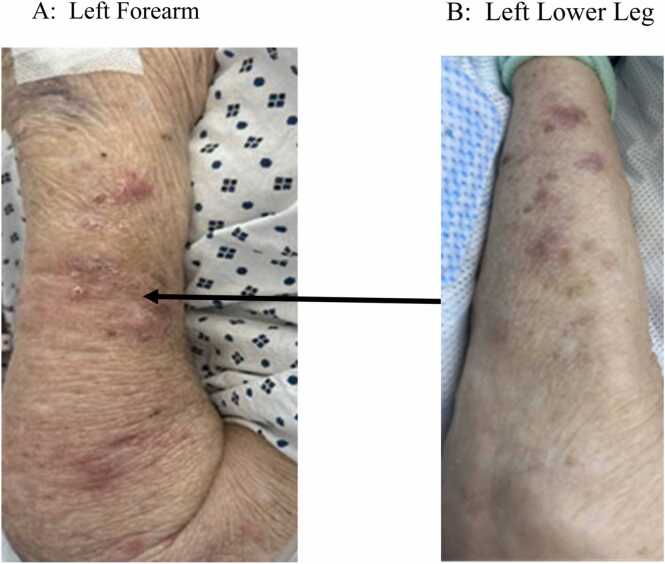 Disseminated Mycobacterium Chelonae infection in an immunocompromised adult: An uncommon etiology of skin infection