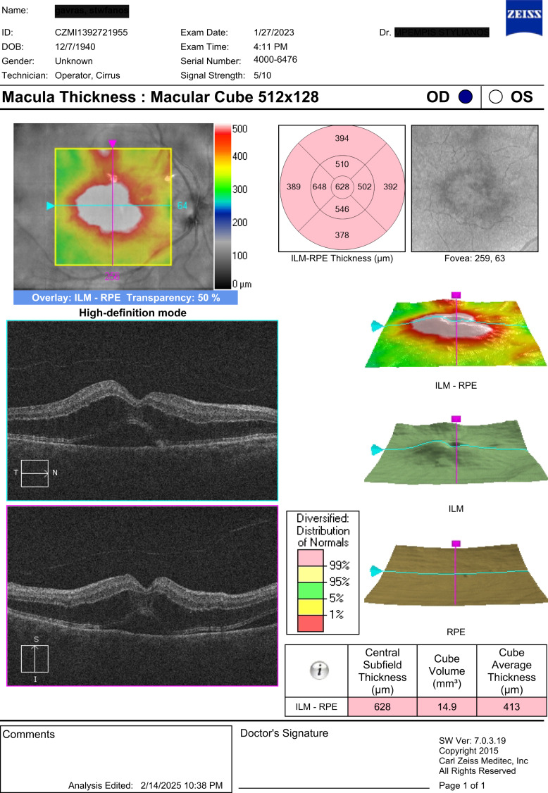 Cefuroxime-Induced Toxic Maculopathy after Intracameral Injection of Standard Dose: A Case Report.