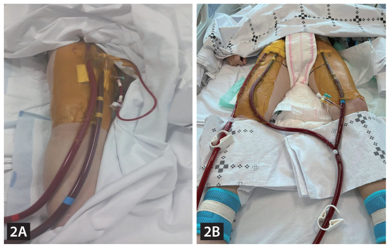 Femoral veno-arterial extracorporeal membrane oxygenation with a novel biatrial cannula for venous drainage and left ventricular venting.