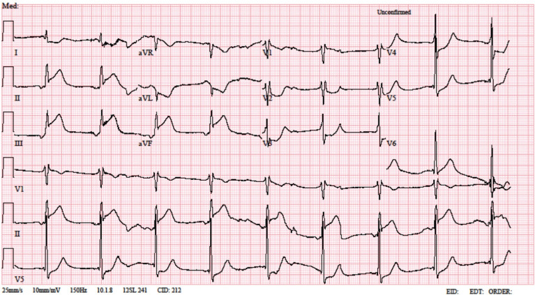 Uncorrectable hypoxemia due to large pulmonary arteriovenous malformation in a patient with myocardial infarction: a case report.