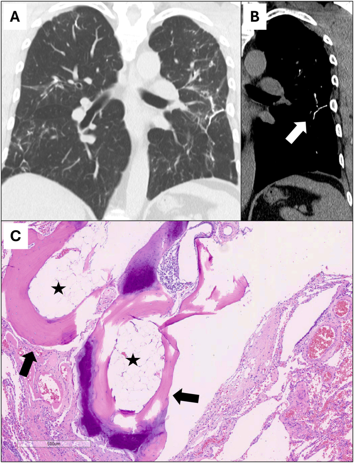 Dendriform pulmonary ossification in military combat veterans: A case series