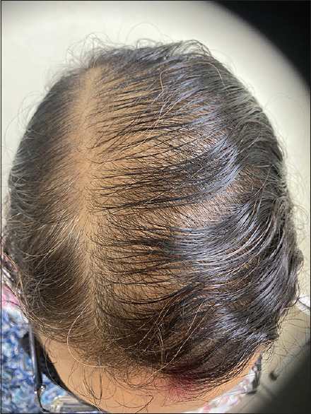 Telogen Effluvium Following Coronavirus Disease-2019 Infection: A Retrospective Study of 113 Cases.