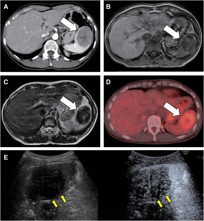 Sclerosing Angiomatoid Nodular Transformation of the Laparoscopically Resected Spleen: Case Reports and Review of the Literature.