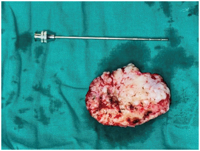 Para-Falcine Chondroma: An Entity of Unacquaintance-A Case Report and Review of Literature.