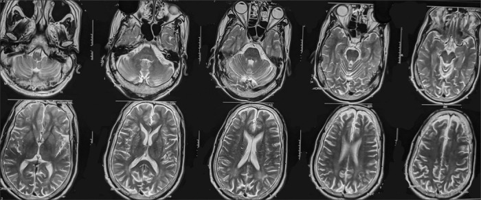 Alcohol dependent and GTCS patient with sleep-related hyper motor epilepsy.