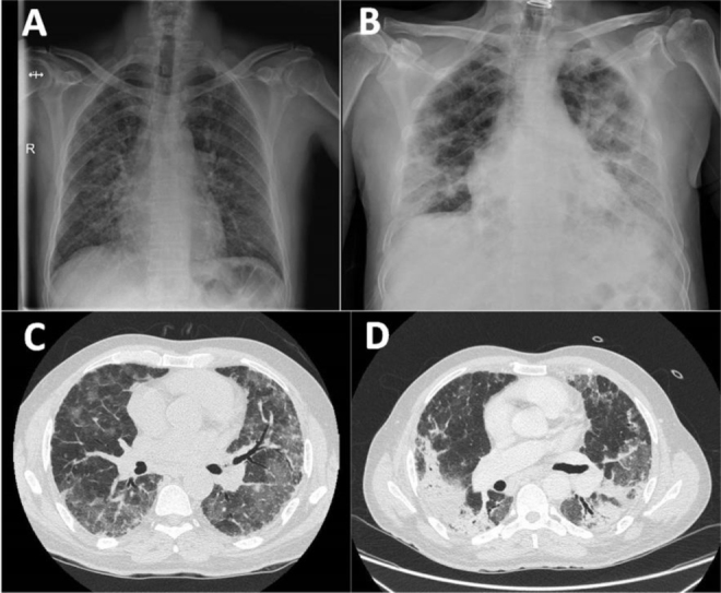 Bilateral Organizing Pneumonia Secondary to Rhinovirus Infection in a Patient With a Solid Organ Transplant