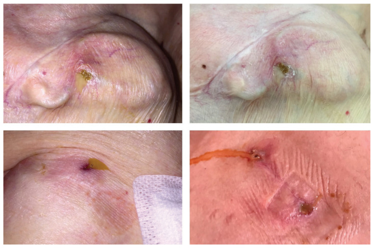 The effect of an antibacterial envelope on cardiac implantable device-related infection - A real-world analysis from a tertiary center.