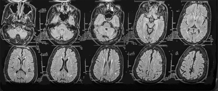 Alcohol dependent and GTCS patient with sleep-related hyper motor epilepsy.