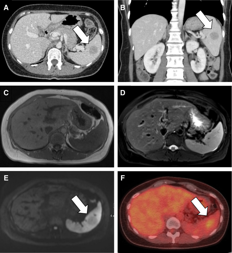 Sclerosing Angiomatoid Nodular Transformation of the Laparoscopically Resected Spleen: Case Reports and Review of the Literature.
