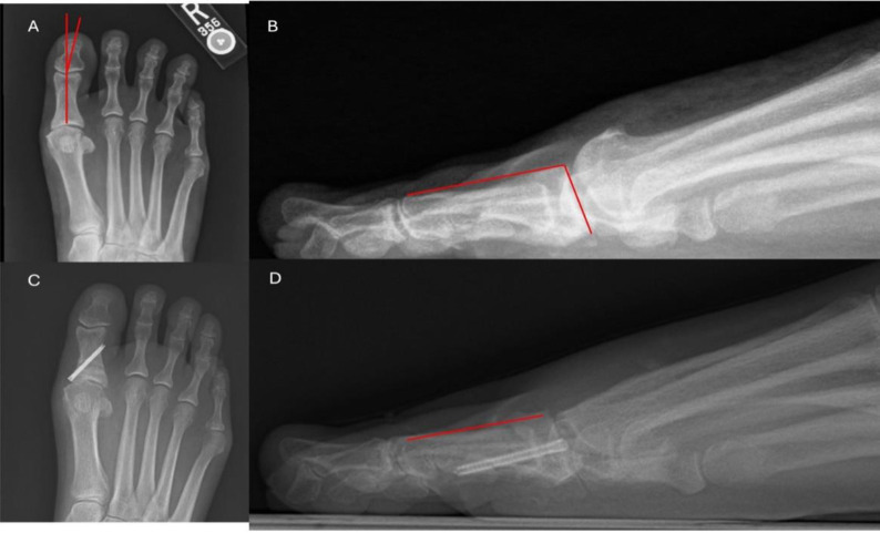 Minimally Invasive vs Open First Metatarsophalangeal Joint Cheilectomy: Radiographic Outcomes and Early Complications.