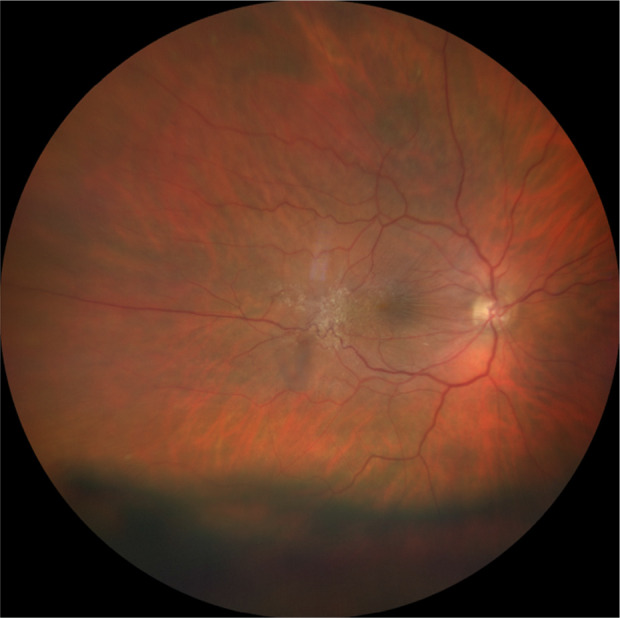 Surgical maculopathies: epiretinal membranes and full-thickness macular holes.