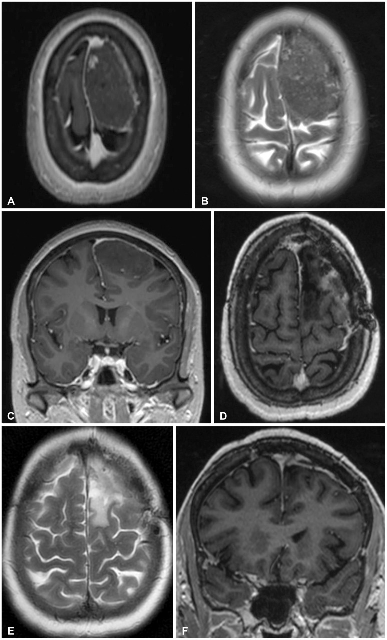 Para-Falcine Chondroma: An Entity of Unacquaintance-A Case Report and Review of Literature.