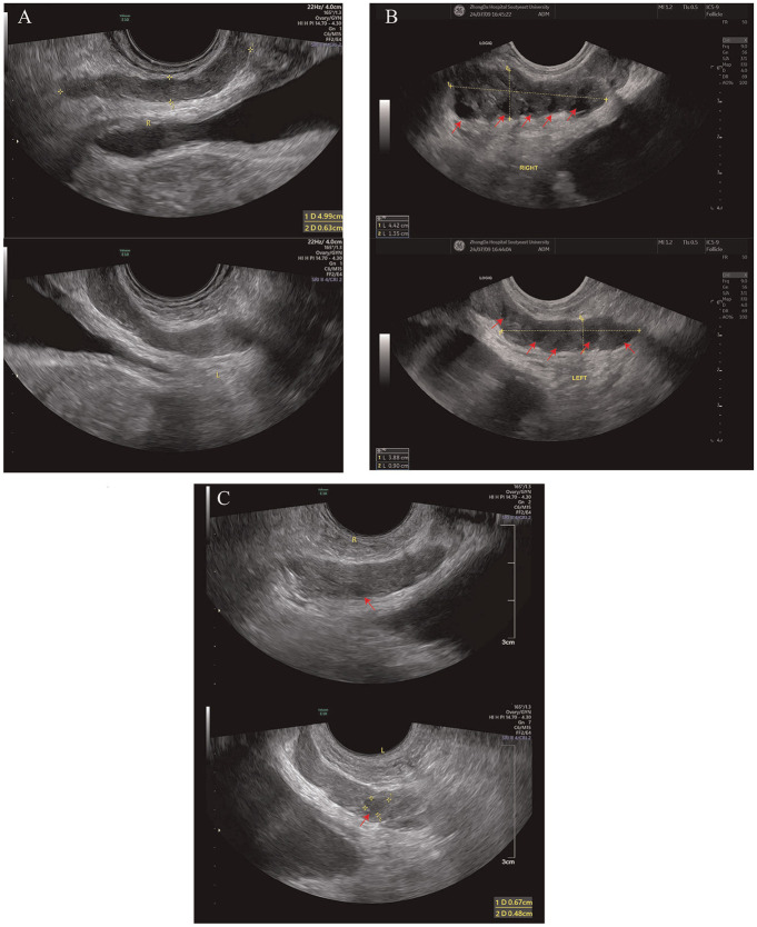 Abnormal Ultrasound Characteristics of Seminal Vesicles in Patient With Anejaculation: A Case Report.