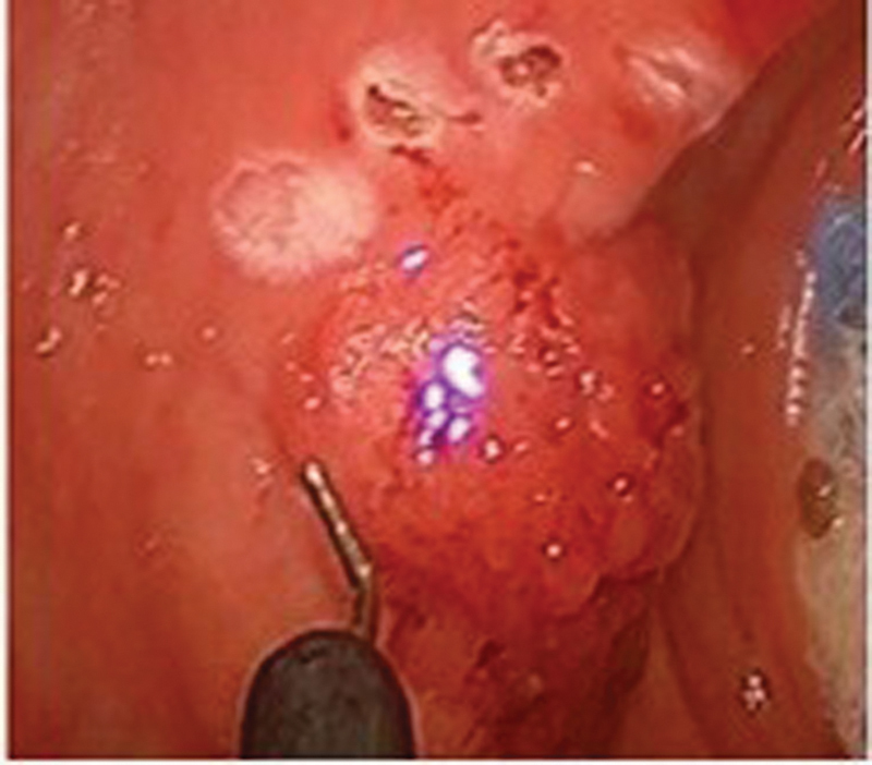 Transanal Minimally Invasive Surgery for Rectal Cancer.