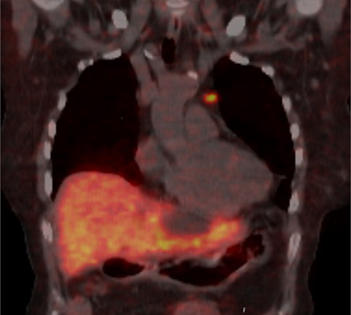 Ectopic Corticotropin-Releasing Hormone/Adrenocorticotropic Hormone-Co-Secreting Neuroendocrine Tumors Leading to Cushing's Disease: A Case Presentation and Literature Review.