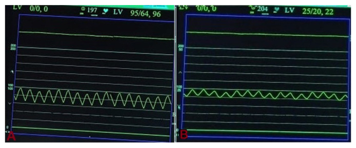 How to Avoid Arterial Access During Transcatheter Closure of Patent Ductus Arteriosus Using Anatomo-haemodynamic Landmark.
