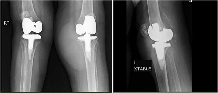 Unmasking tuberculous arthritis in a prosthetic joint: Diagnostic and therapeutic challenges