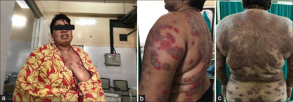 Management of painful pemphigus vulgaris - Relieving pain and restoring dignity.