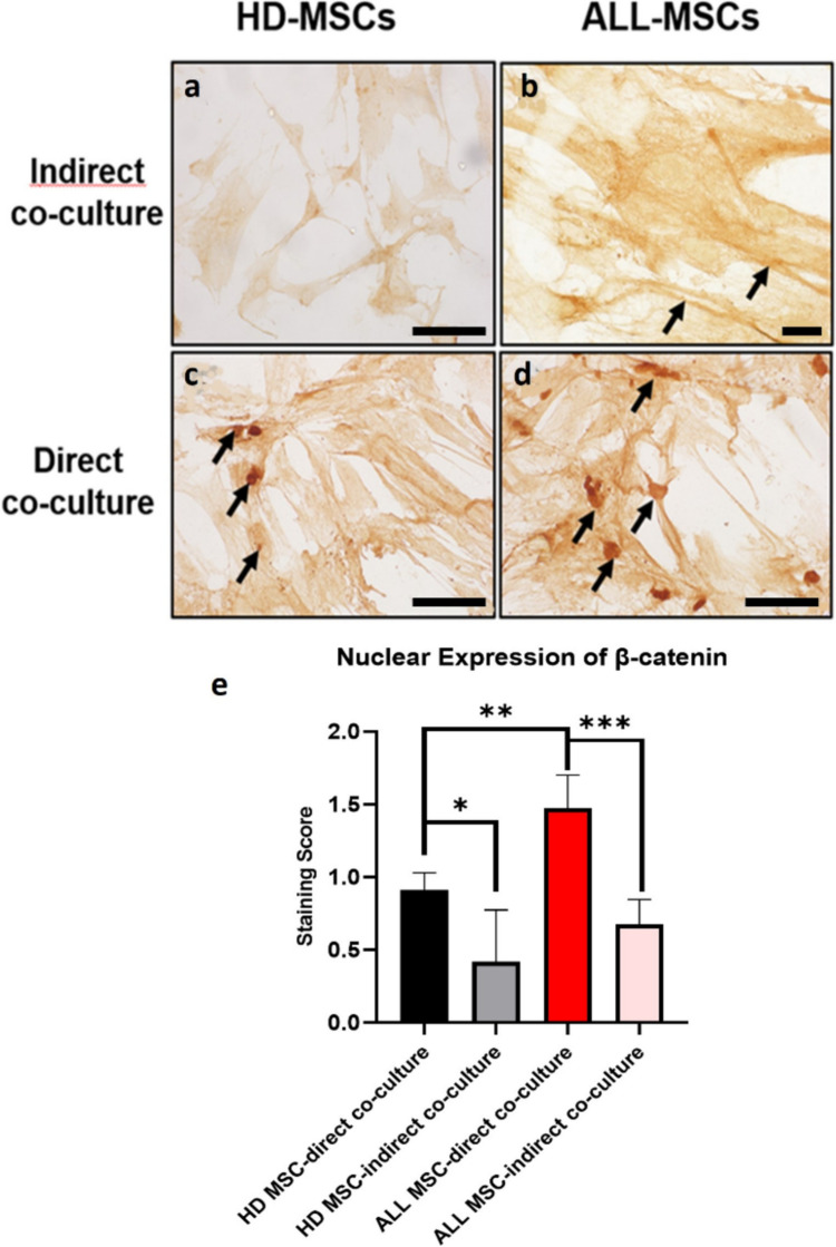 The dynamic interaction of pediatric ALL cells and MSCs: influencing leukemic cell survival and modulating MSC β-catenin expression.