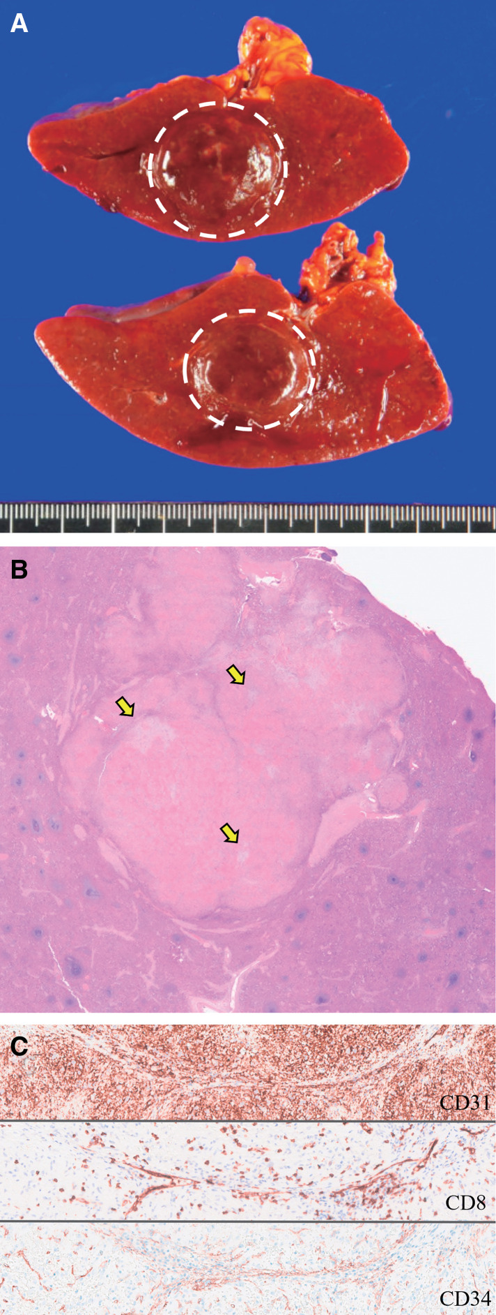 Sclerosing Angiomatoid Nodular Transformation of the Laparoscopically Resected Spleen: Case Reports and Review of the Literature.