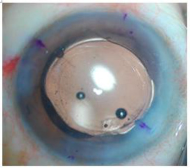 A prospective study to compare the safety and efficacy of toric intra-ocular lens vs. opposite clear corneal incision in patients undergoing phacoemulsification for age-related cataract with pre-existing corneal astigmatism.