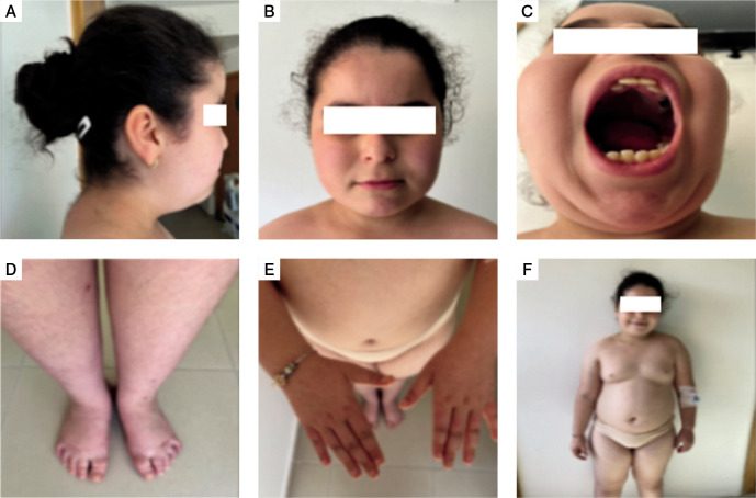 Association of ring chromosome 18 and Prader-Willi syndrome: the first described case report.