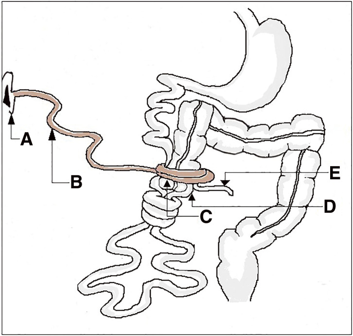 Meckel's Diverticulum Mimicking a Postoperative Flange with Acute Intestinal Obstruction and Midgut Volvulus: A Case Report.