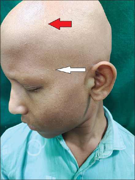 Atrichia Congenita with Papular Lesions: A Report of Rare Case Showing "Cluster of Stars' Appearance on Dermoscopy".
