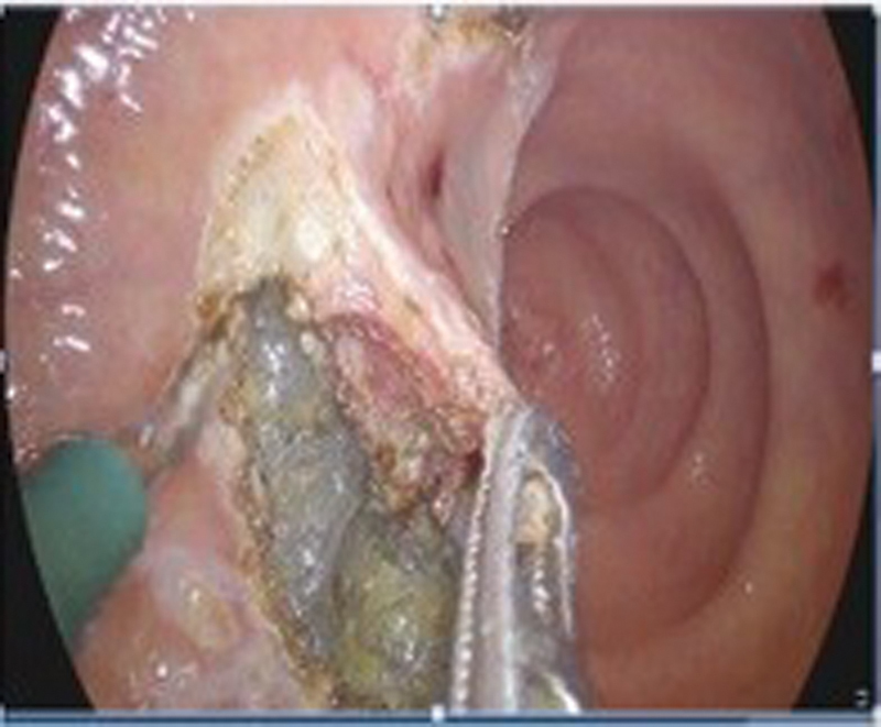 Transanal Minimally Invasive Surgery for Rectal Cancer.