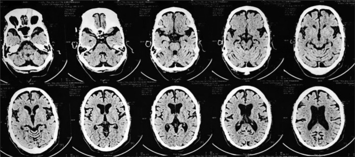 Distinctive lorazepam response in catatonia with cognitive impairment.