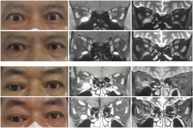 A curative effect evaluation of intensity-modulated radiation therapy combined with periorbital triamcinolone acetonide injection in treating thyroid eye disease patients with active extraocular muscle but low CAS.
