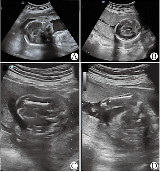 Identification of a Fetal De Novo Splice Variant in <i>ARCN1</i> Associated With Growth and Skeletal Abnormalities.
