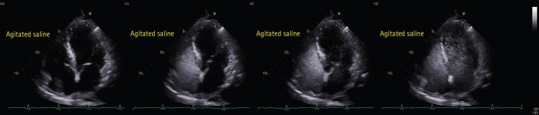 Uncorrectable hypoxemia due to large pulmonary arteriovenous malformation in a patient with myocardial infarction: a case report.