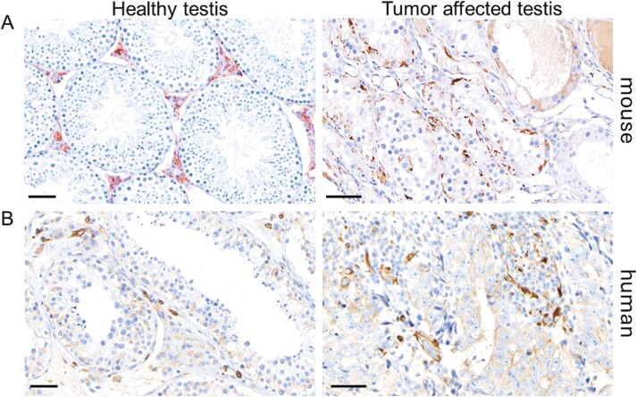 Testicular sex cord-stromal tumors in mice with constitutive activation of PI3K and loss of Pten.