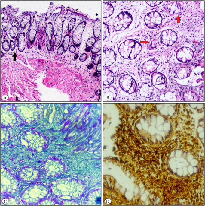 Solitary Rectal Ulcer Syndrome - A Rare Entity in the Pediatric Population.