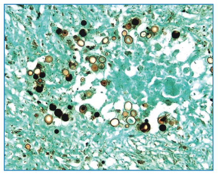 Paracoccidioidomycosis of the testis.