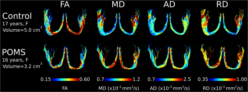 Disproportional smaller fornix with altered microstructure in pediatric multiple sclerosis shown by high-resolution fluid-suppressed diffusion tractography.
