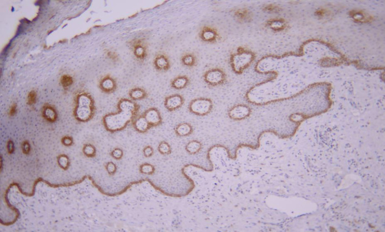 Evaluation of Cytokeratin 19 Expression in Oral Carcinogenesis.