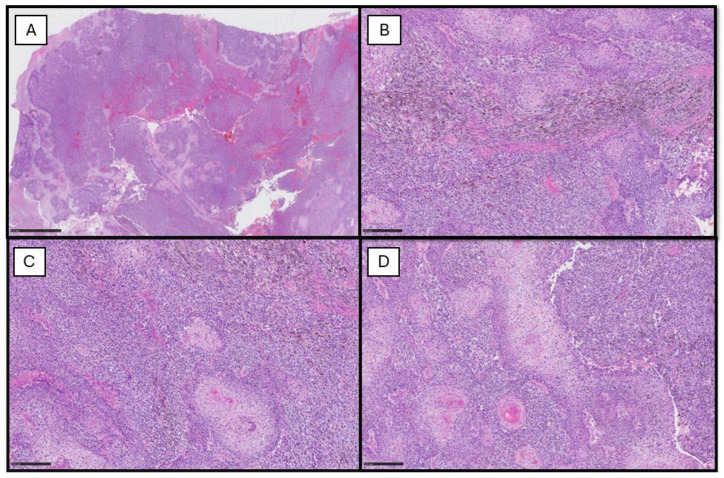Squamomelanocytic Tumor, An Entity Still Shrouded in Mystery: Case Report and Literature Review.