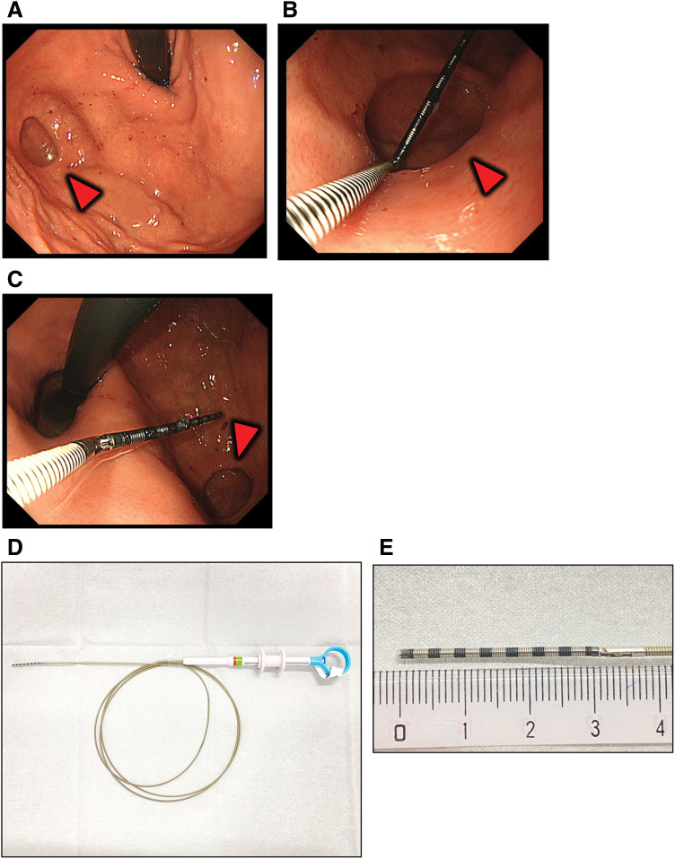 Obese Patient with Gastric Diverticulum Undergoing Laparoscopic Sleeve Gastrectomy Guided by Preoperative Endoscopic Measurement: A Case Report and Literature Review.