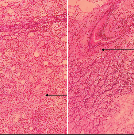 Idiopathic sialadenosis mimicking neoplasms: Clinical and histopathological considerations.
